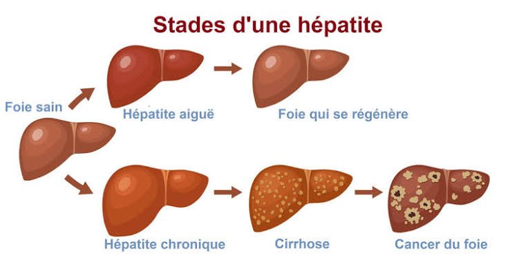 Santé: Journée Mondiale contre les Hépatites